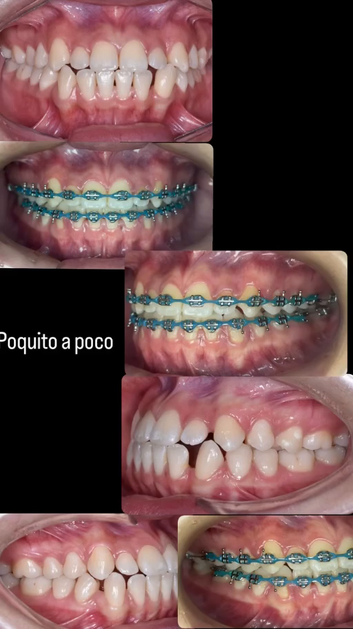 Vista frontal inicial del caso 1 con brackets