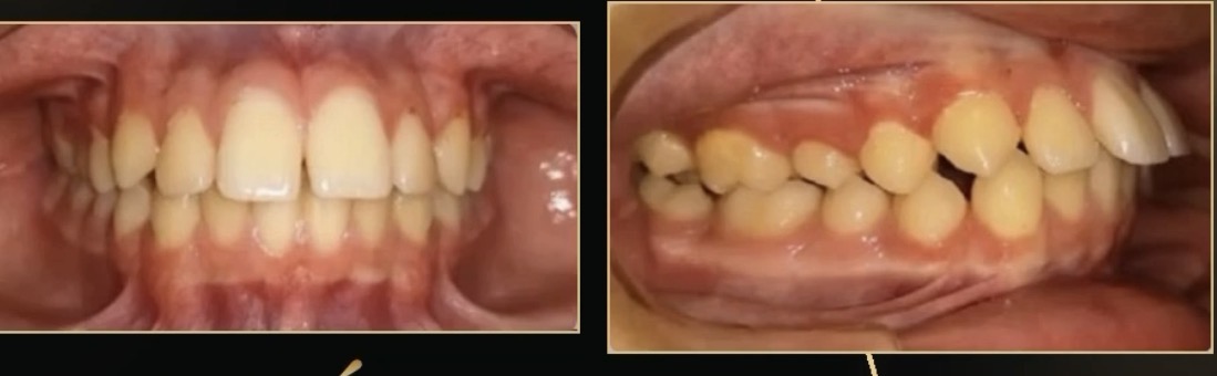 Vista frontal inicial del caso 2, fotografía proporcionada por el Dr. Kafati