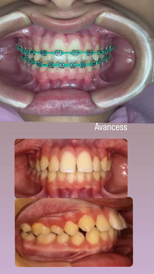 Vista frontal del avance con brackets del caso 2